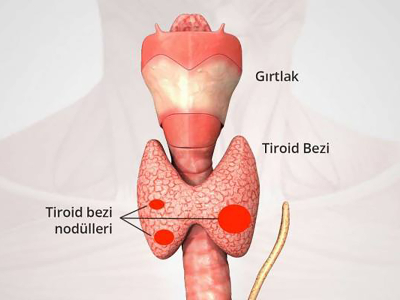 Guatr ve Tiroid Kanseri