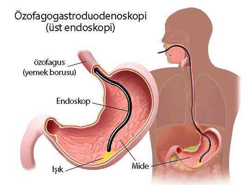 Endoskopi Nedir